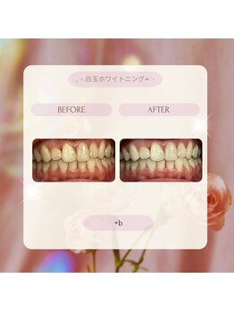 プラスビーセルフ(+b self)/ホワイトニングビフォーアフター