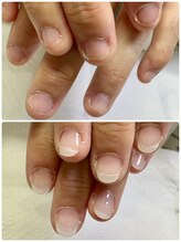 ネイルフレーバー(Nail Fravor)/深爪矯正ナチュラルコース