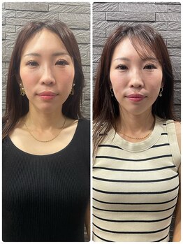 長寿鍼灸院 長寿整骨院/ハリネズミ女優美容鍼効果★