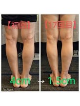 クシロ鍼灸整骨院/【O脚矯正】施術例