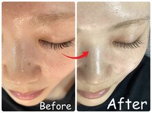 エレ(ele)/【施術3回】肌質改善ハーブ◎