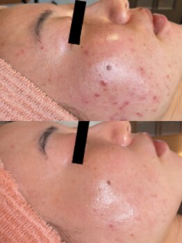 フェミプレイス(Femi Place)/もうニキビで悩まない