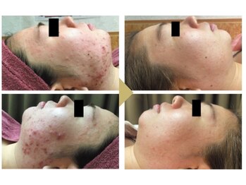 ジョン ハンプトンの写真/毛穴詰まり解消でニキビ＆黒ずみ対策！至近距離でも自信のもてる素肌へ