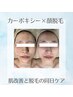 【延べ4万人突破記念】圧倒的支持率◎顔脱毛×カーボキシーシェービング付