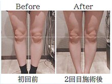 美容整体 ゼン(zen)/【骨盤矯正】O脚やX脚の改善