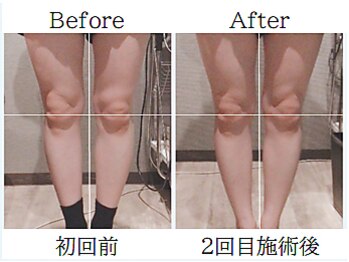 美容整体 ゼン(zen)/【骨盤矯正】O脚やX脚の改善