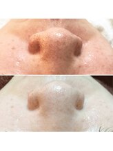 エシャーム(echarme)/カーボンピーリング