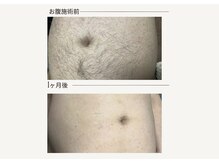 クレビア(CREVIA)/メンズおなか脱毛◆BeforeAfter