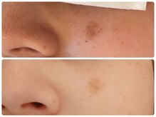 ブリリアント(Brilliant)/光フェイシャルでシミケア