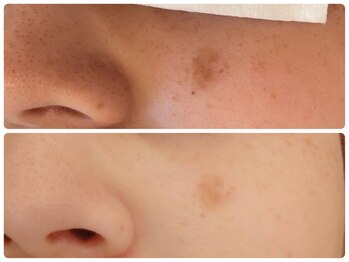 ブリリアント(Brilliant)/光フェイシャルでシミケア