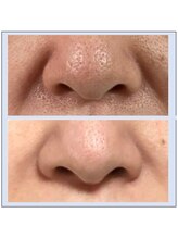 シュシュレ 博多(ShushuLe)/50代３ヵ月/毛穴ケアほうれい線