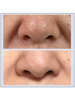 シュシュレ 博多(ShushuLe)/50代３ヵ月/毛穴ケアほうれい線