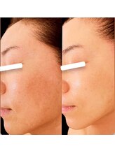 ジーニー(Genie)/ララピール