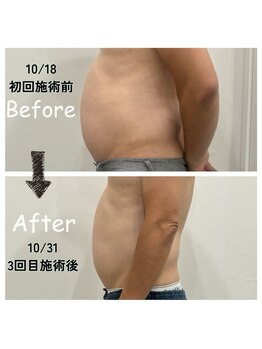 ナニワ ビューティー(naniwa beauty)/お腹WINBACK