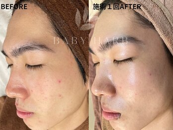 フィズ 戸塚店(FIS)/☆ハーブピーリング☆都度払い