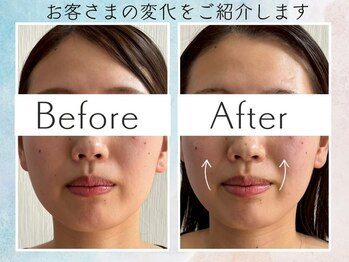 さくら鍼灸院 整骨院/美容鍼4