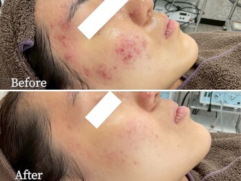 ニキビケア 毛穴研究所 立川店/頬からフェイスラインニキビケア