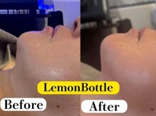 ビースキン 広島(BE:SKIN)/レモンボトル/たるみ/引き締め