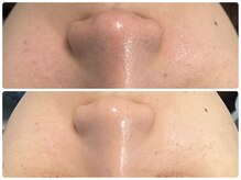 アンドナイン エス店(ANDNINE.)/毛穴洗浄