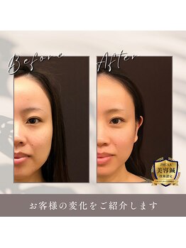 うぃず鍼灸整骨院/【立体造顔美容鍼・小顔調整】