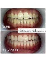 ホワイトニングサロン 京都烏丸店/ホワイトニング施術例