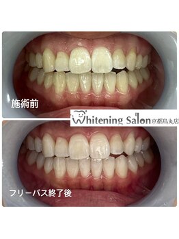 ホワイトニングサロン 京都烏丸店/ホワイトニング施術例