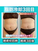 ビューティ ウィッチ(Beauty Witch)/脂肪冷却3回目