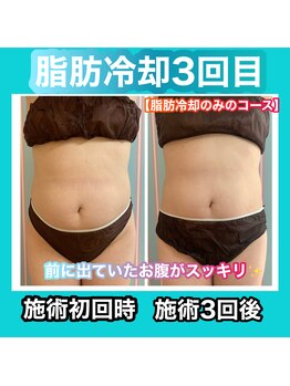 ビューティ ウィッチ(Beauty Witch)/脂肪冷却3回目