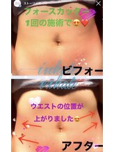 アンリール 旭川店(Anrire)/BODY施術のお客様です！