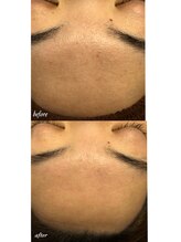 フルール(Fleur)/◆おでこを磨きあげる◆