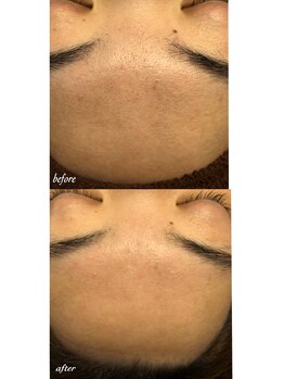 フルール(Fleur)/◆おでこを磨きあげる◆