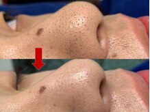 ブリリアン デイスパ 阪急西宮ガーデンズ店(BRILLIAN DAYSPA)/毛穴洗浄フェイシャル