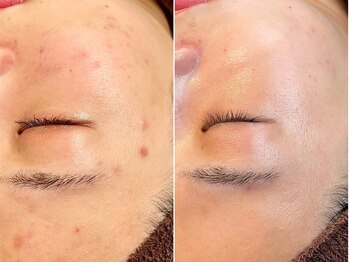 ウル(Uru)/次世代ハーブピーリング