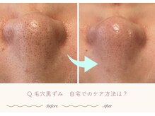 エステティックサロン シーズ/Q.自宅でのケア方法は？