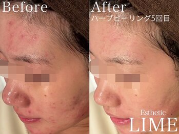 ライム 松本(LIME)/ハーブピーリング|ニキビケア