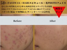ベルアンドヘルス 千葉(BELL&HEALTH)/FACEWAX×塗るニードル×光PHOTO