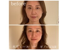 人気No.1施術最新美容機器【ギノーVARフェイシャル】