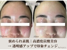 レガロビューティクリエイションズ桜川店/高濃度炭酸肌改善フェイシャル