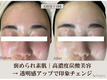 レガロビューティクリエイションズ桜川店/高濃度炭酸肌改善フェイシャル