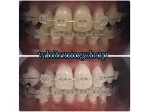 ホワイトニングショップ 鈴鹿店/Before&After美白ホワイトニング