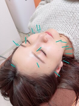 ヒーリングサロン アージュ(A-je)/★美顔鍼＋小顔矯正★
