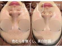 アルフォービューティー 恵比寿店(ALU for beauty)/色むら・美白症例
