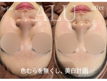アルフォービューティー 恵比寿店(ALU for beauty)/色むら・美白症例
