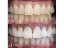 ハリス(HARIS)/セルフホワイトニング