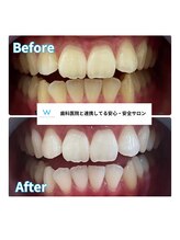 ホワイトニングショップ 甲府店/ホワイトニングの効果