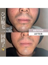 アカラビューティー(Akala Beauty)/ひげ脱毛〈１回目終了！！〉