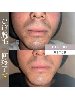 アカラビューティー(Akala Beauty)/ひげ脱毛〈１回目終了！！〉