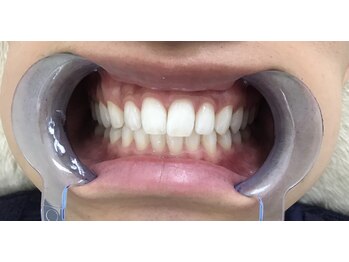 エクシアホワイトニング 日本橋店/白い歯