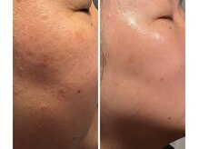 フーレスト アンド フリーリー(Fullest&Freely)/第四世代！ララピール＆フォト