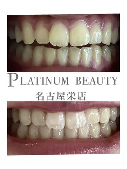 プラチナムビューティー 名古屋栄本店(PLATINUM BEAUTY)/お客様Before After
